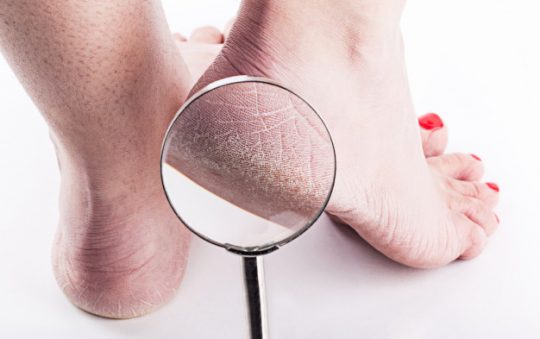 Comment éliminer les callosités des pieds ?