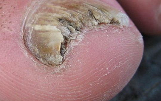 Comment soigner un champignon sous l’ongle du gros orteil ?