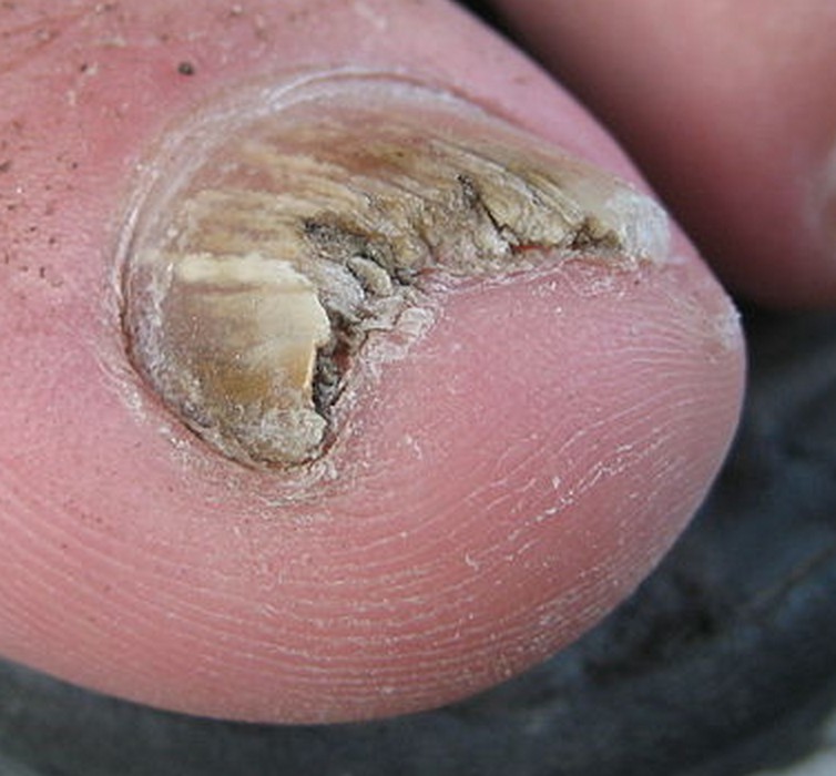 Comment soigner un champignon sous l’ongle du gros orteil ?